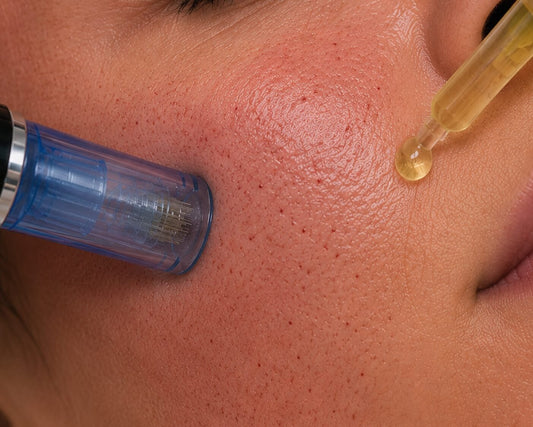 Microneedling with PRP
