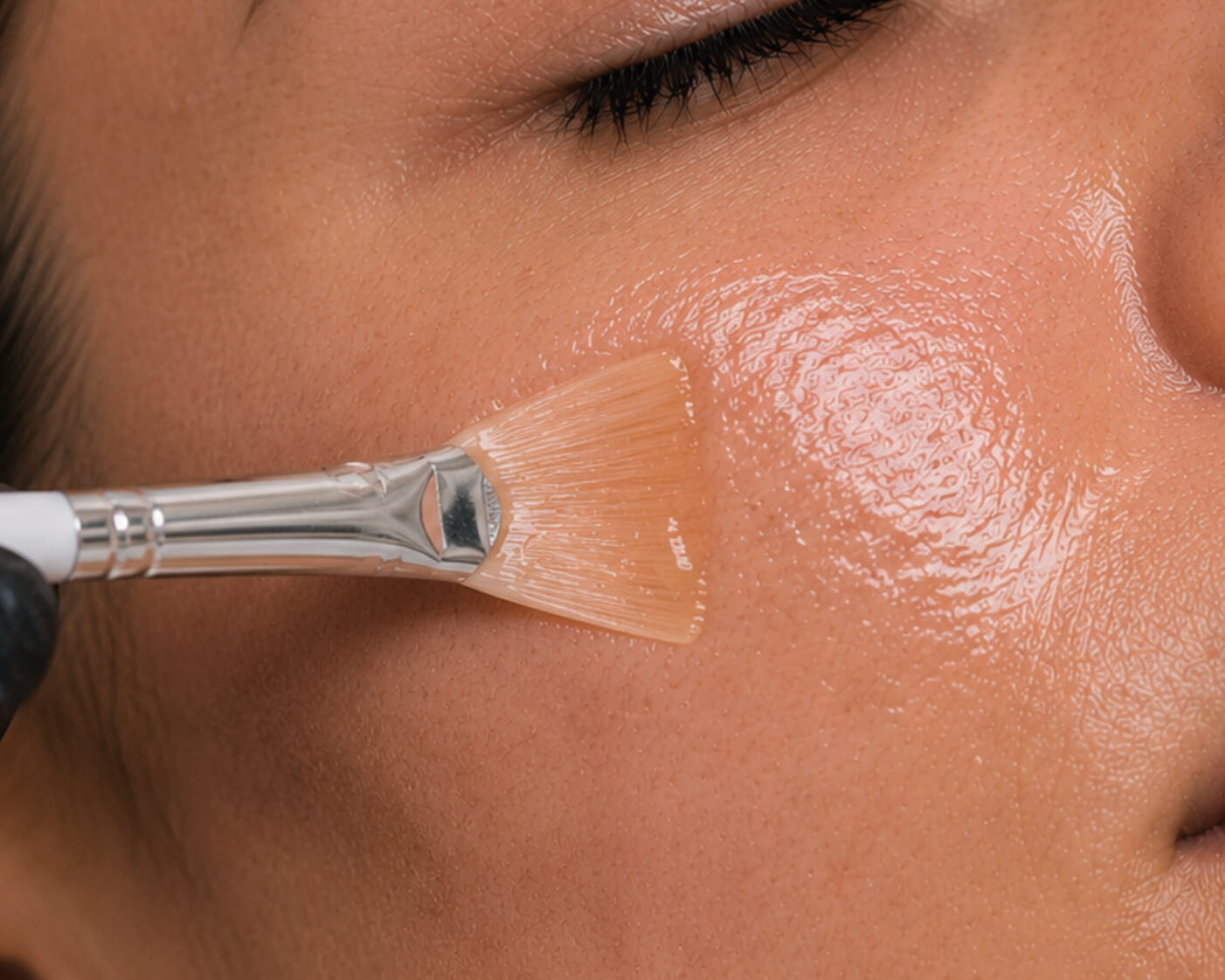 Moderate Grade Chemical Peel
